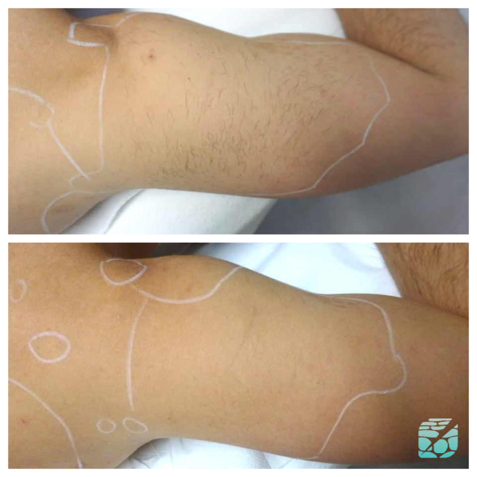 Permanente Ontharing - Laserontharing Full Body -  Tanden Bleken in Genk - SoCleanClinic.be thumbnail
